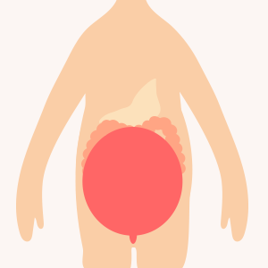 妊娠中の子宮で腸管が圧迫されているイメージ画像