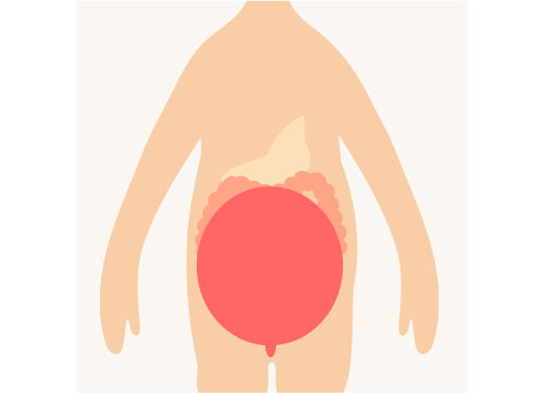 妊娠中の子宮で腸管が圧迫されているイメージ画像