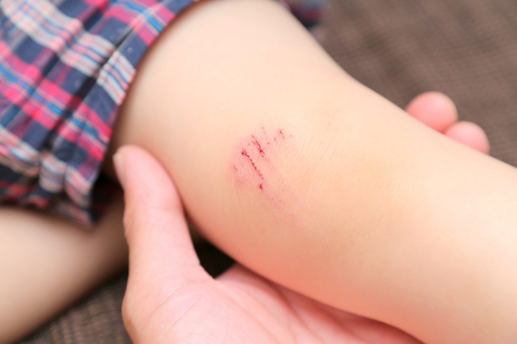 口の怪我の予防