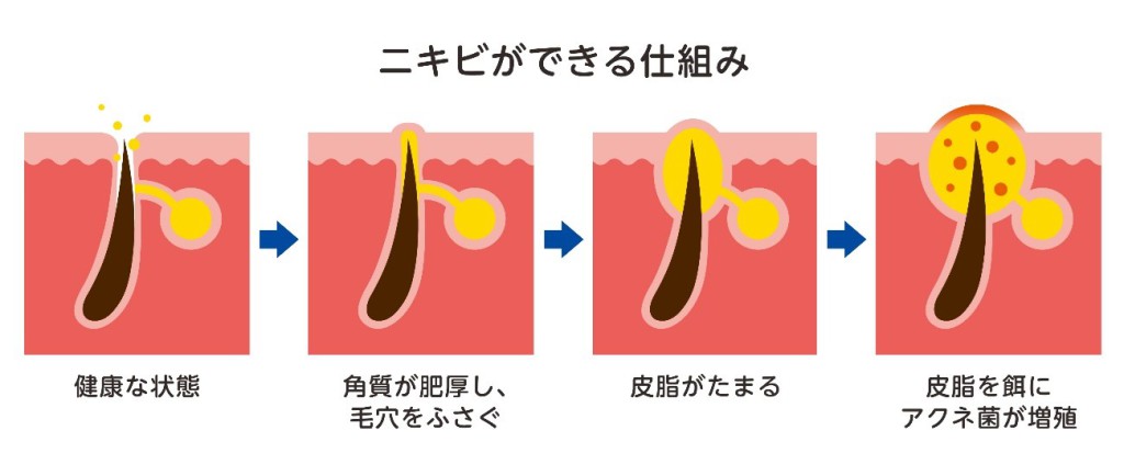 医師監修 乾燥肌は保湿するとニキビができる 正しいスキンケアを紹介 健栄生活