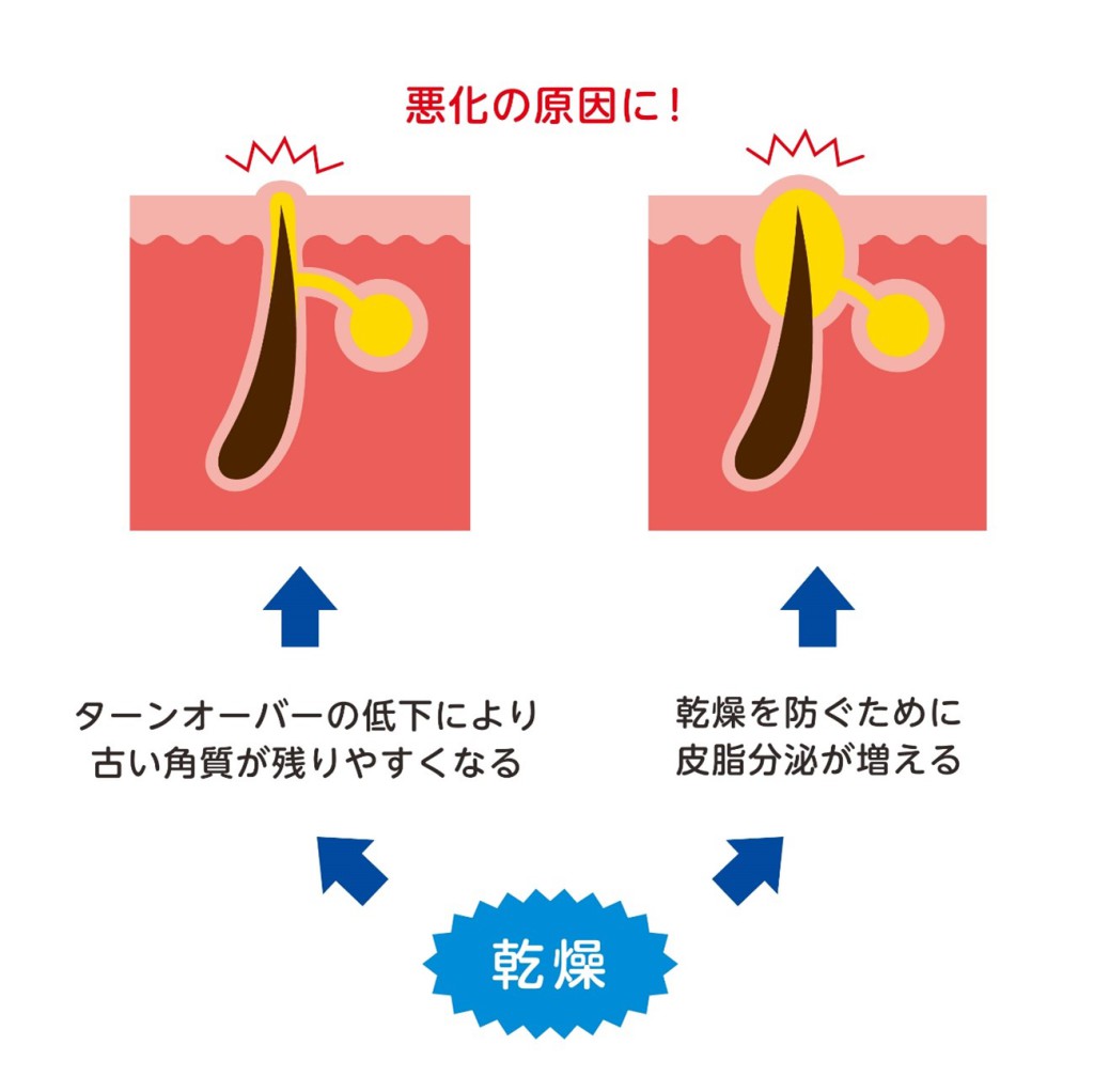 医師監修 乾燥肌は保湿するとニキビができる 正しいスキンケアを紹介 健栄生活 医師監修 乾燥肌は保湿するとニキビができる 正しいスキンケアを紹介 健栄生活