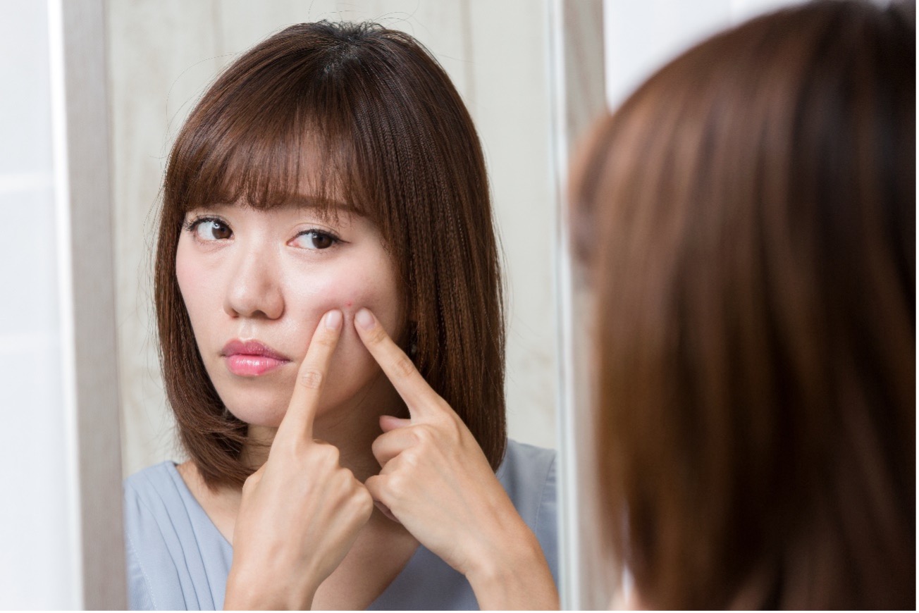 ニキビ痕の改善方法はある？原因や治るまでの期間を解説