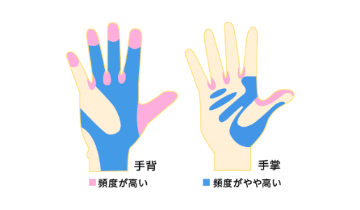 手洗いミスの発生部位の図